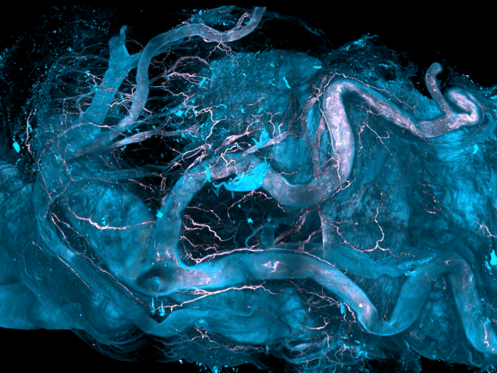 Bhatia et al. developed DISCO-MS, a 3D spatial-omics technology that uses robotics to obtain proteomics data from cells identified early in diseases. Image shows the aortic regions of a human heart whose vascular plaques are analyzed by DISCO-MS technology.